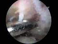 Arthroscopic Subacromial Decompression