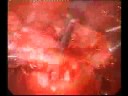 Cystic uterine myoma.Laparoscopic treatment Cystic uterine myoma.Laparoscopic treatment