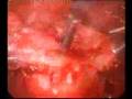 videos de Cystic uterine myoma.Laparoscopic treatment