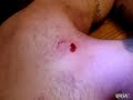 This guy has the world's biggest zit oozing with disgusting puss.