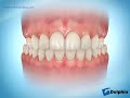 Correcting Posterior Crossbite Using Rubber Bands
