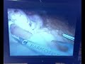 Live stream from america hospital 1 second delay