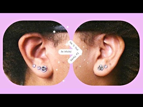 how to cure infected ear piercing