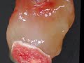 Left atrial myxoma