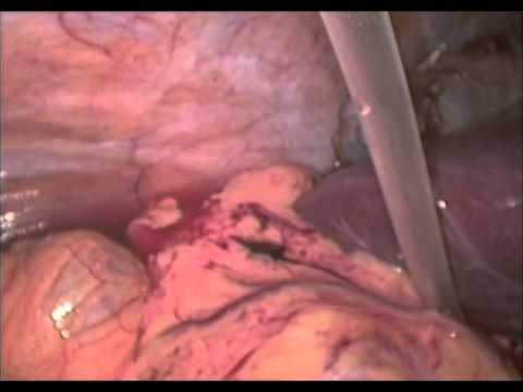 Λαπαροσκοπική χολοκυστεκτομή 