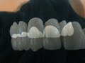 Noritake EX3 metal ceramic bridge