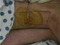 Popliteal block