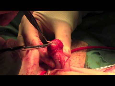 penectomy