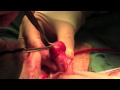 Total glans resurfacing for premalignant and malignant penile lesions