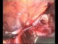 laparoscopic management of deep endometriosis
