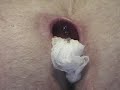 Pilonidal Excision Post Op Week 2