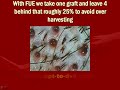 FUE & FUT Compete or Complete FUE & FUT Compete or Complete