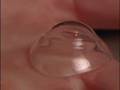 Scleral Contact Lenses-Mayo Clinic