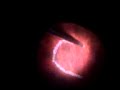 Submacular Retinal Pigment Epithelium Transplantation