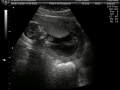 Mataya ultrasound part 1