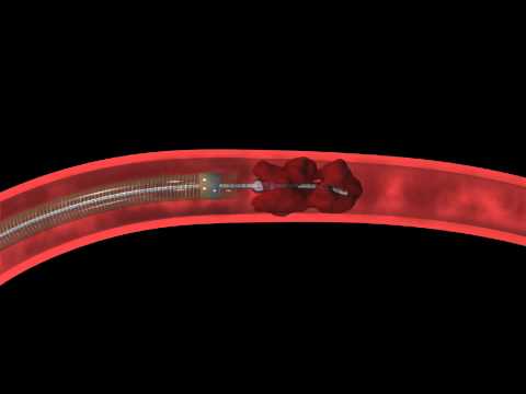 micro catheter - The Penumbra System is designed to revascularize large vessel occlusions in the intracranial circulation. The Penumbra System uses a unique microcatheter and...