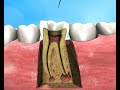 The Apexum Procedure- root canal treatment, produced by Virtual Point