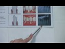 Teeth Whitening : Identifying Advanced Periodontitis Teeth Whitening : Identifying Advanced Periodontitis
