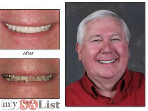 how to whiten travertine
