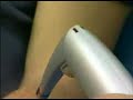 Advanced Cryotherapy