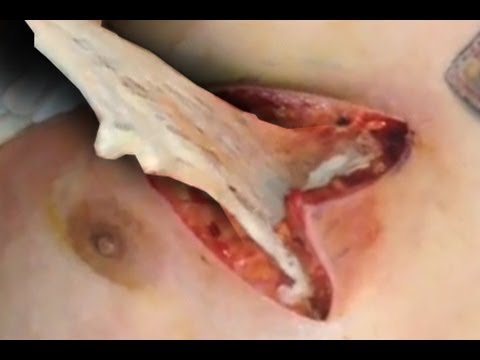 how to treat open boil wound