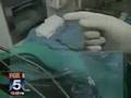 SmartLipo (Fox News NY)