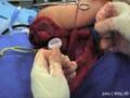 Prosthesis Of Scapula Radical Removal Due To Sarcoma Of The Ewing - Part 5