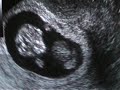 10 Weeks 2 Days Ultrasound