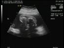this is the dvd made of the ultrasound we did last wednesday.