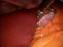 IntraOperative Video: Mini-Gastric Bypass