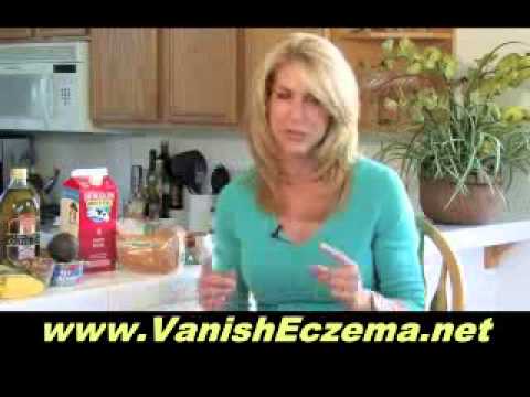how to treat varicose eczema
