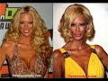 consecuencias de la anorexia   consequences of anorexia