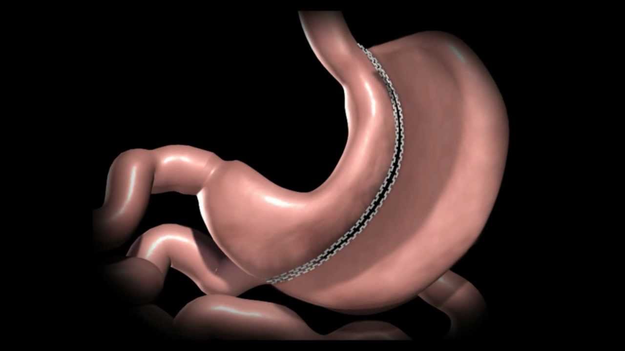 Gastric Sleeve 3D Explained Canada