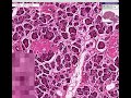 Histopathology Pancreas--Hyalinized islets