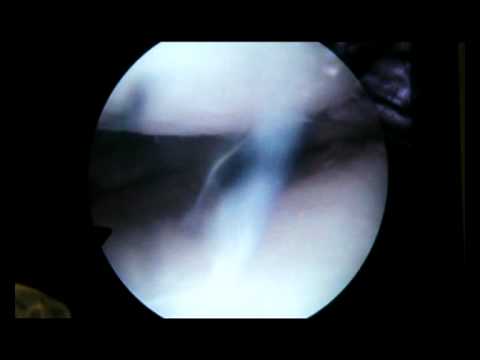 Ruptura menisci medialis genus sin