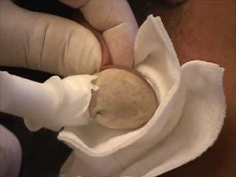 how to relieve keloid pain