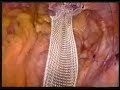 Laparoscopic Sacral Colpopexy