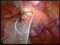 Laparoscopic Sacral Colpopexy