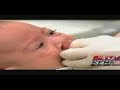 KENS5 with Dr. Tim Hensen - Cleft lip/palate - UTHSCSA