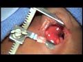 Patent Ductus Arteriusus (PDA) performed on Premature Baby - Pediatric Heart Surgery Patent Ductus Arteriusus (PDA) performed on Premature Baby - Pediatric Heart Surgery