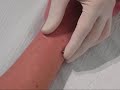 Wrist surface piercing,performed at Urban Piercings. A 14 gauge canula is used, then 1.6mm P.T.F.E is inserted into the piercing.
