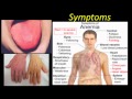 Pernicious Anemia