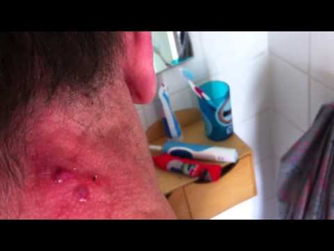 how to pop a cystic acne