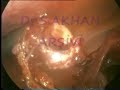 Dr.Suleyman Akhan / Laparoskopik Endometrioma Ameliyatı
