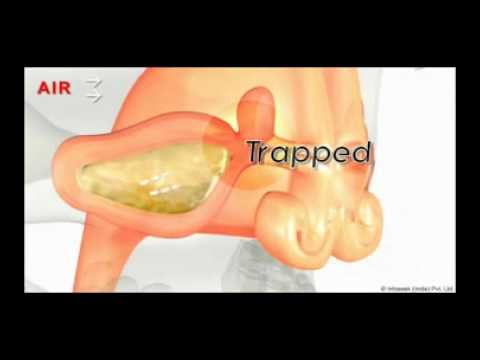 Sinusitis Pathology (Para-nasal ...