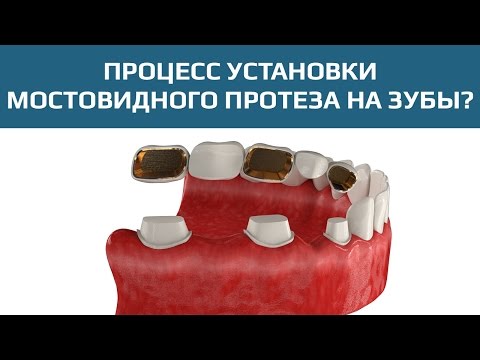 Зубной мост для замещения нескольких зубов
