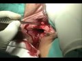 Desgarro-perineal-II