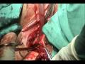 Desgarro-perineal-II
