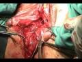Desgarro-perineal-II