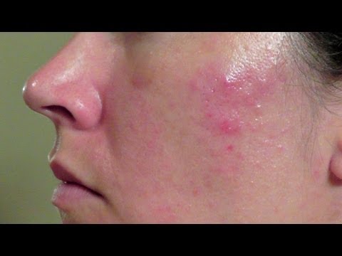 how to get rid of a acne cyst